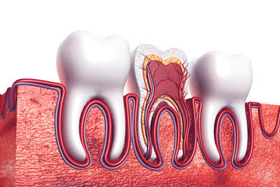 A Root Canal Dentist In Camdenton: Explaining The Basics Of A Root Canal