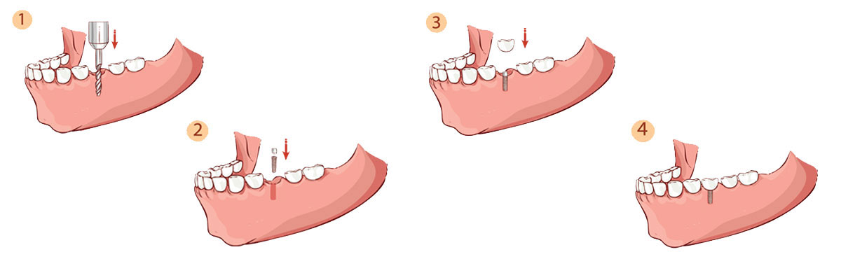 Camdenton Dental Implant Restoration