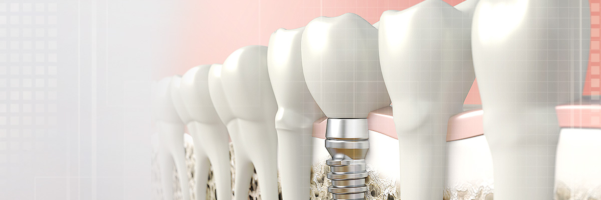 Camdenton Implant Dentist