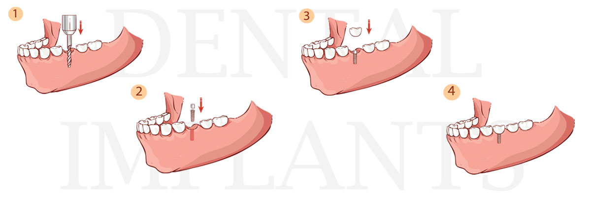 Camdenton The Difference Between Dental Implants and Mini Dental Implants