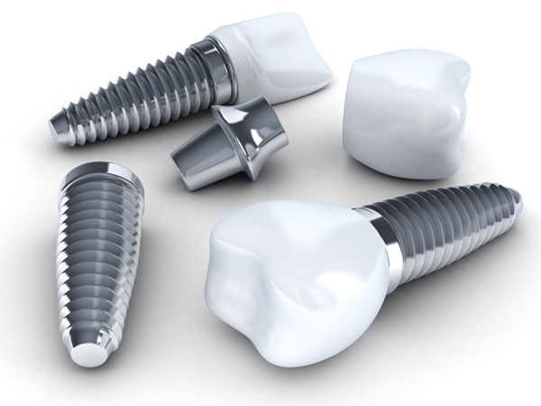The Difference Between Dental Implants and Mini Dental Implants