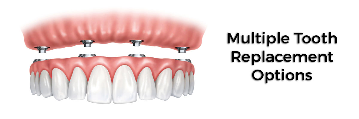 Camdenton Multiple Teeth Replacement Options
