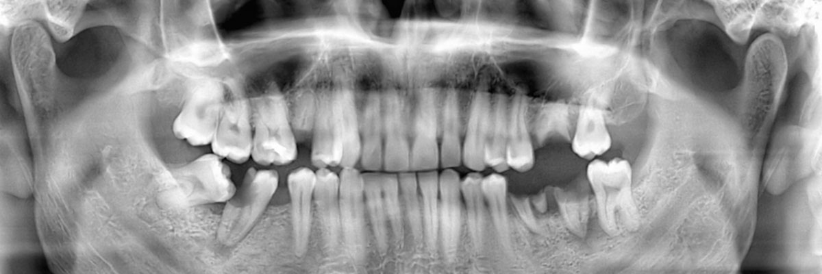 Camdenton Options for Replacing Missing Teeth