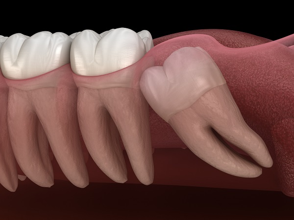 wisdom tooth extraction Camdenton, MO